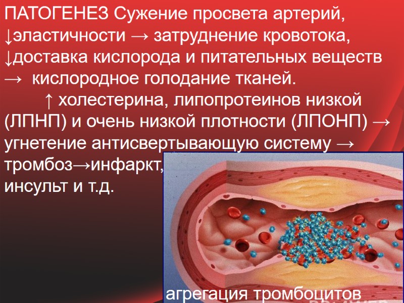 ПАТОГЕНЕЗ Сужение просвета артерий, ↓эластичности → затруднение кровотока, ↓доставка кислорода и питательных веществ →
